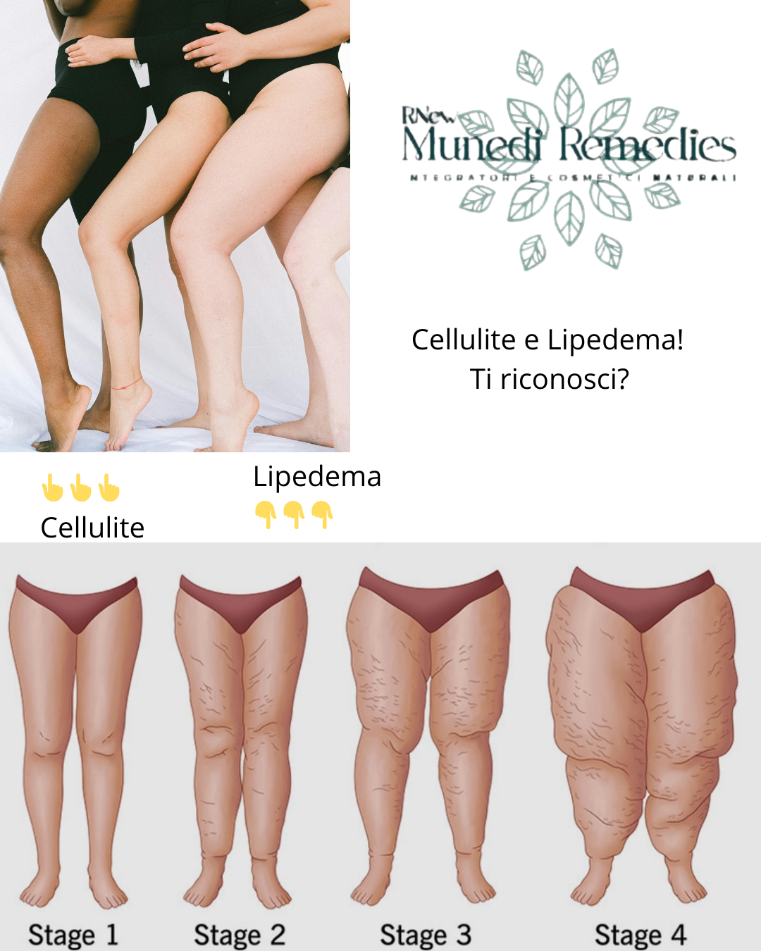 Cellulite o Lipedema?